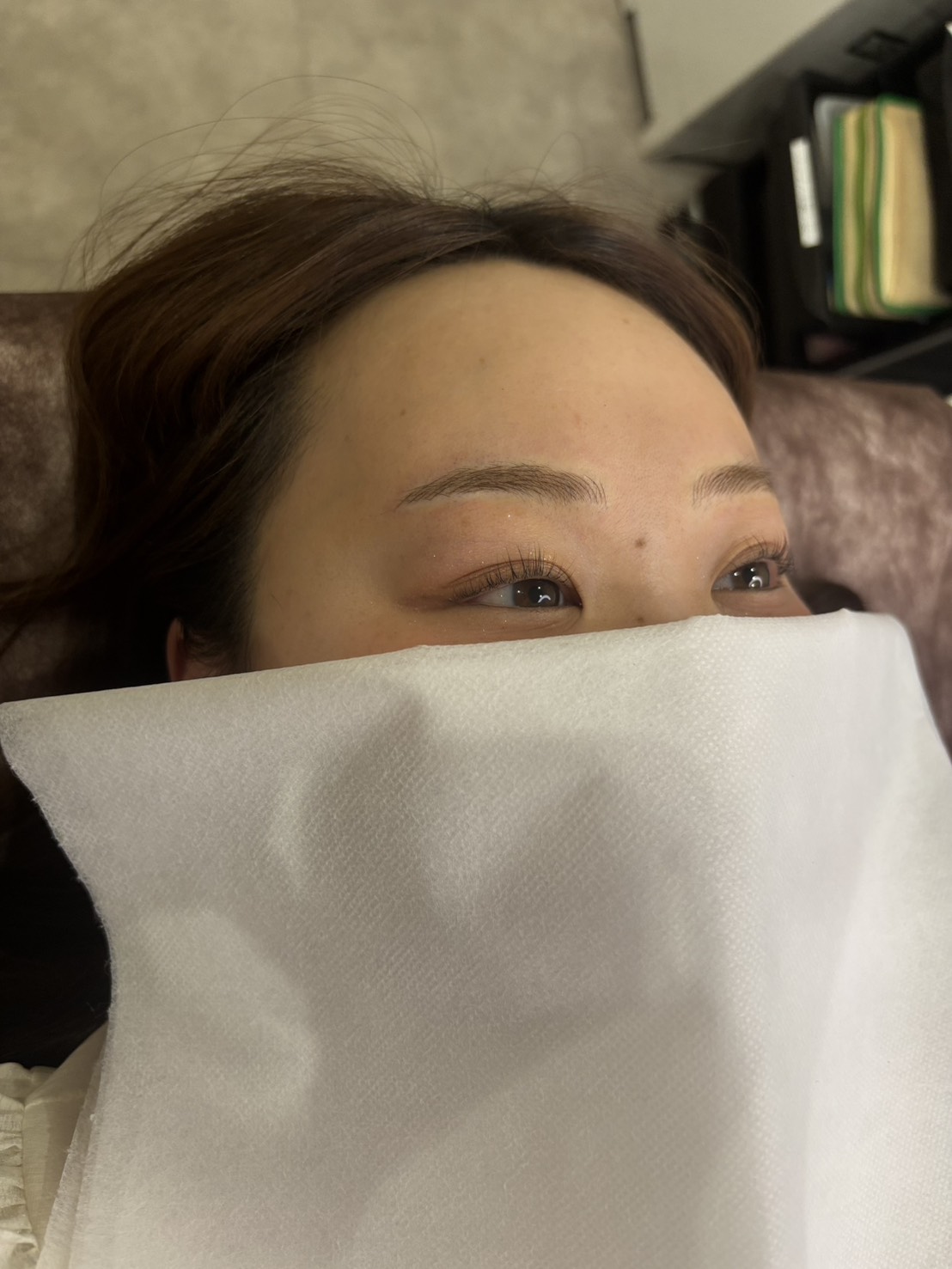 事例1 施術後